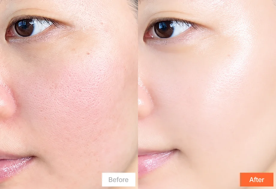 Skin comparison before and after 2 weeks of using Genabelle PDRN 3% Hyper Boost Ampoule