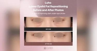 Gangnam dark circles: a changed under-eye shadow with under-eye fat repositioning