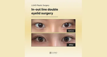 Looking at the changes in eye shape before and after double eyelid surgery through a review