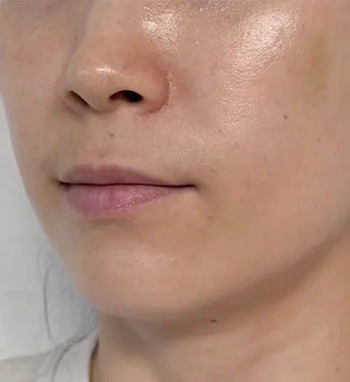 糸リフト