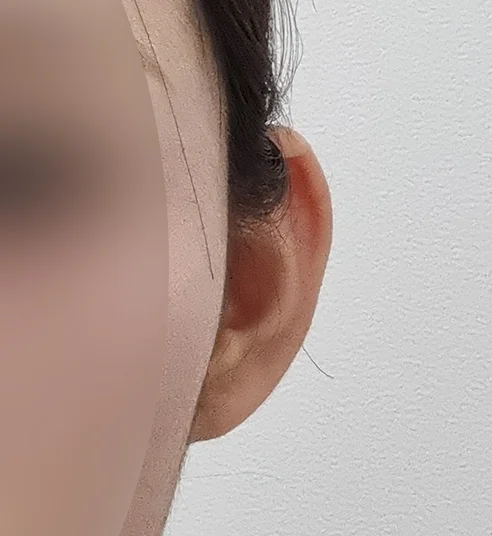 耳フィラー