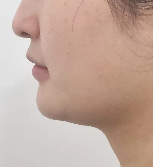 脂肪溶解注射